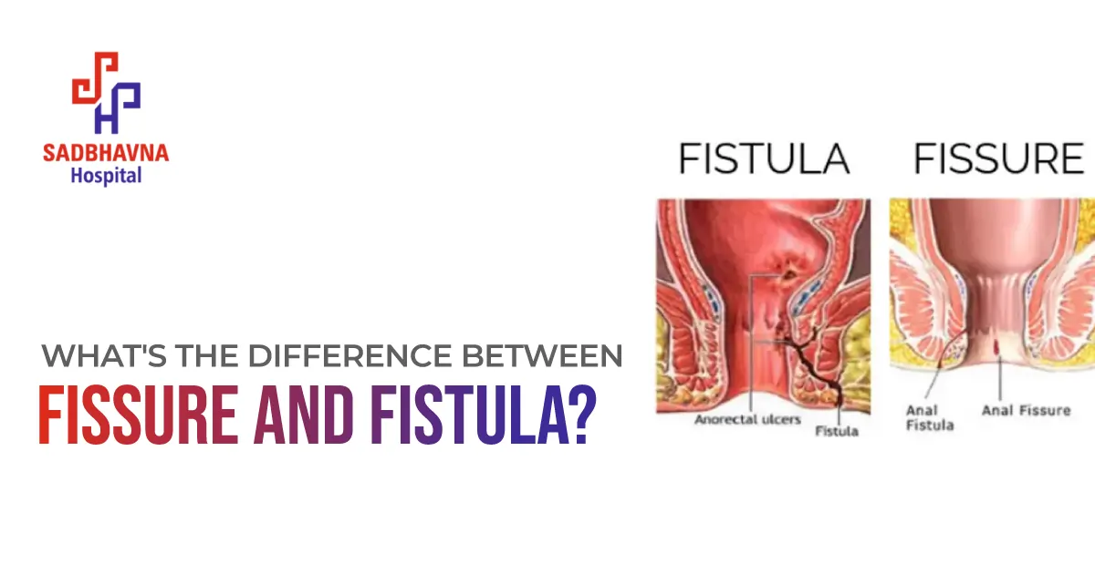 Difference Between a Fissure and Fistula