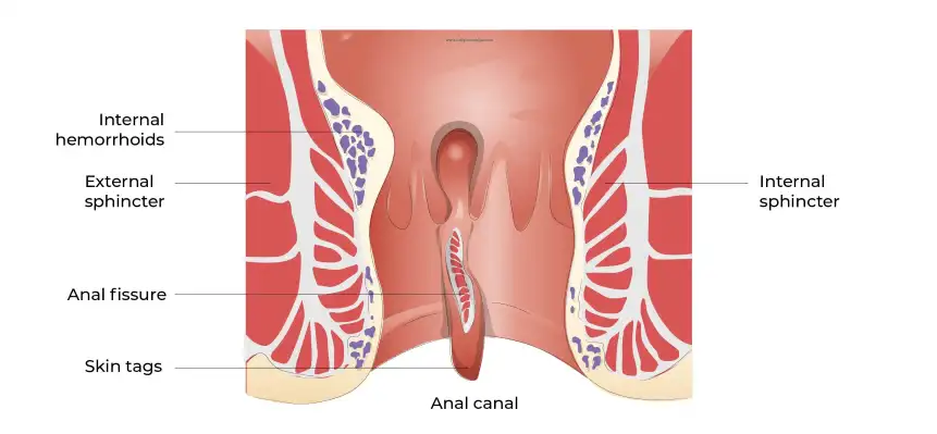 fissure treatment