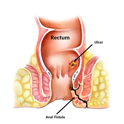 fistula treatment