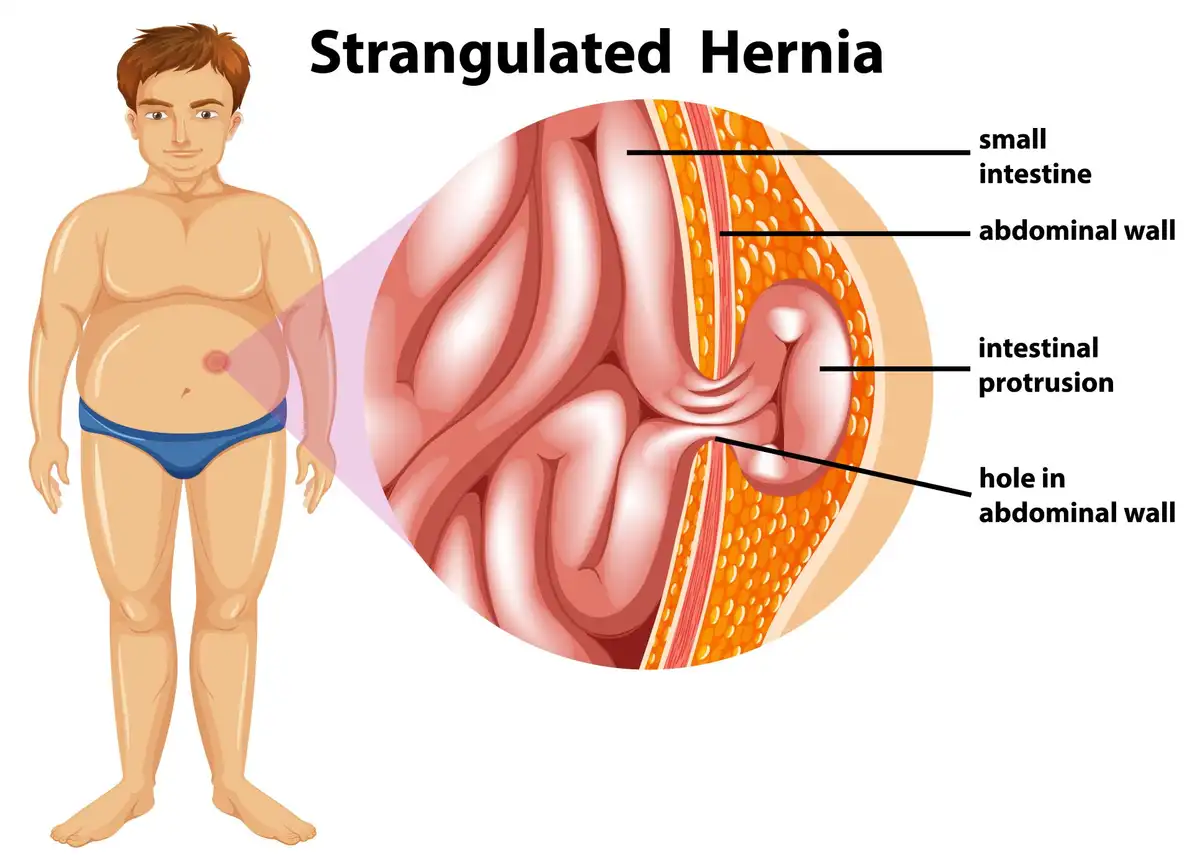 hernia treatment