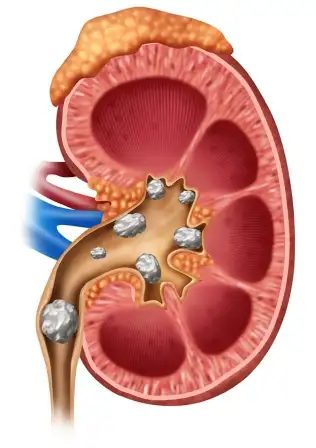 kidney stone treatment