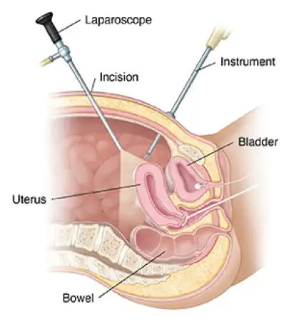 laparoscopic hysterectomy